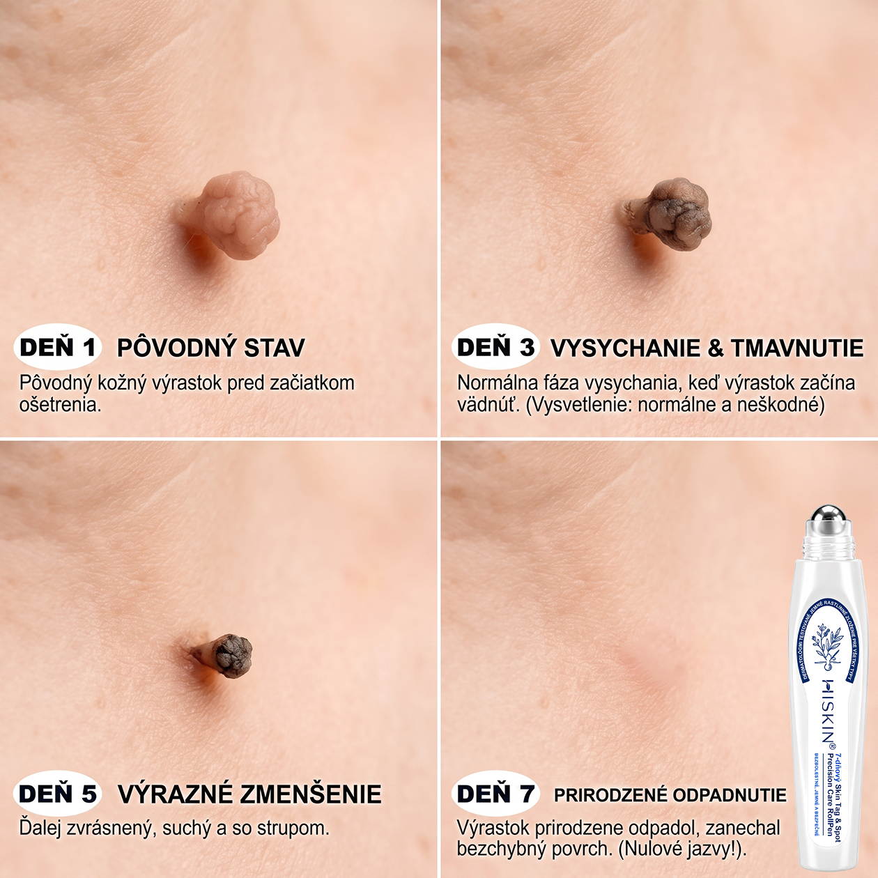 HISKIN®👩‍⚕️ BOTANICKÝ – GUMA NA ŠTÍTKY A ŠKVRNY – Bezbolestná starostlivosť o pokožku bez jaziev s pokročilým guľôčkovým aplikátorom